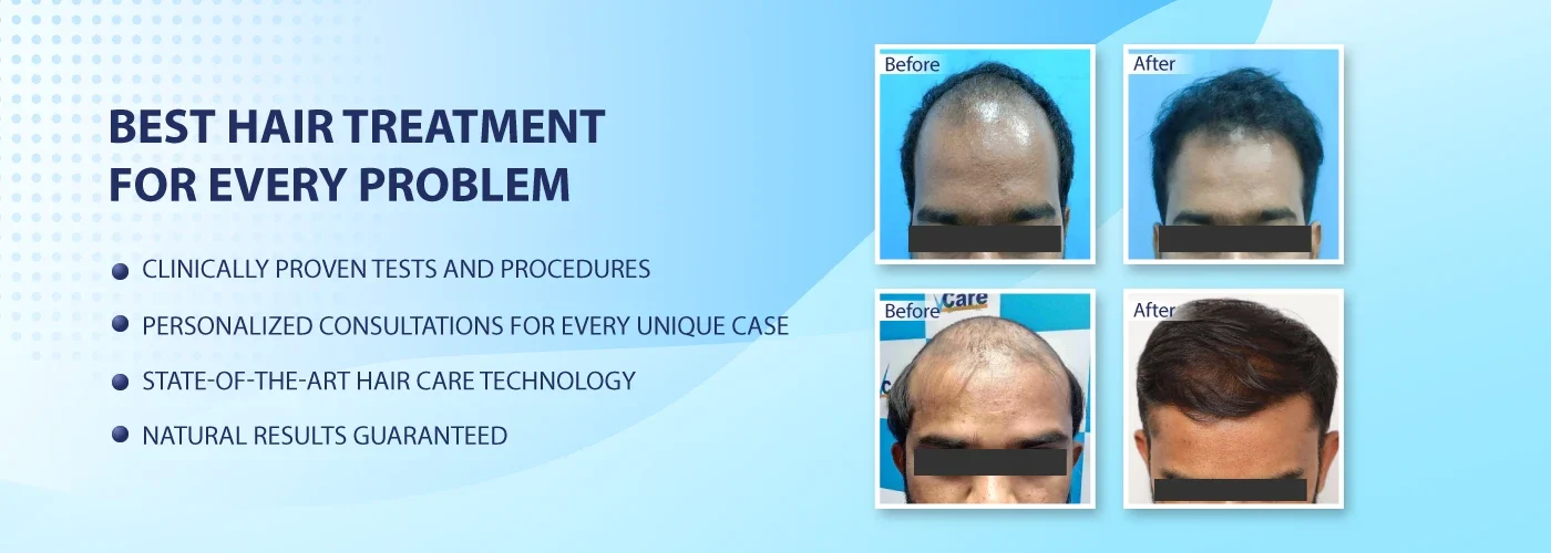 Best Hair Clinic in India Hair Loss Treatment Hair Care Clinic